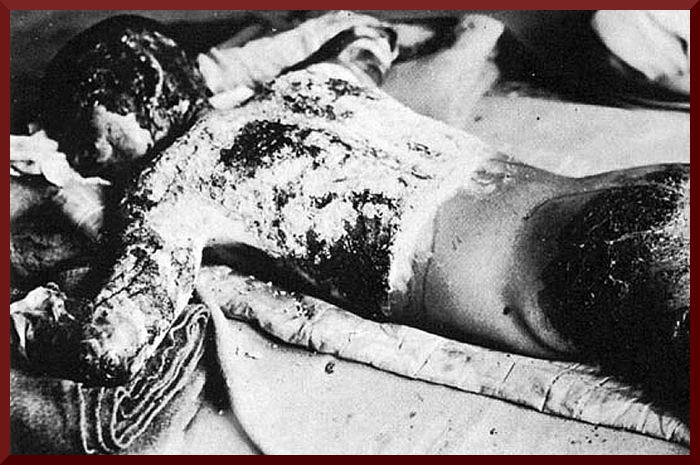 Victim of Atomic Bomb 002