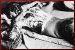 Victim of Atomic Bomb 002